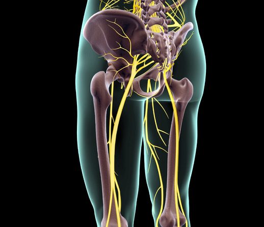 Sciatica