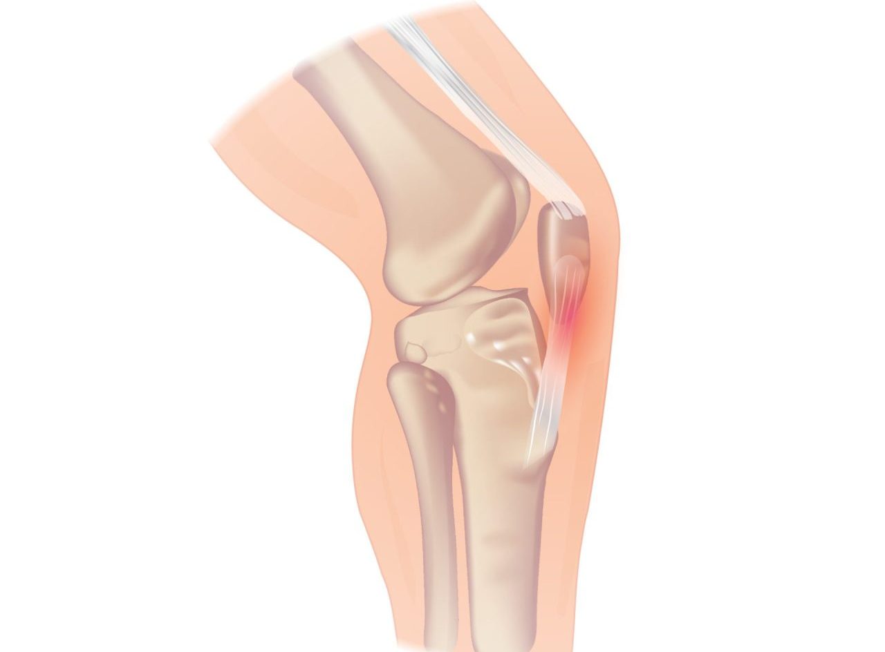 Infrapatellar Fat Pad Impingement