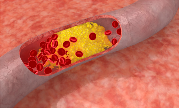 Understanding LDL Cholesterol: The Silent Culprit Behind Cardiovascular Health