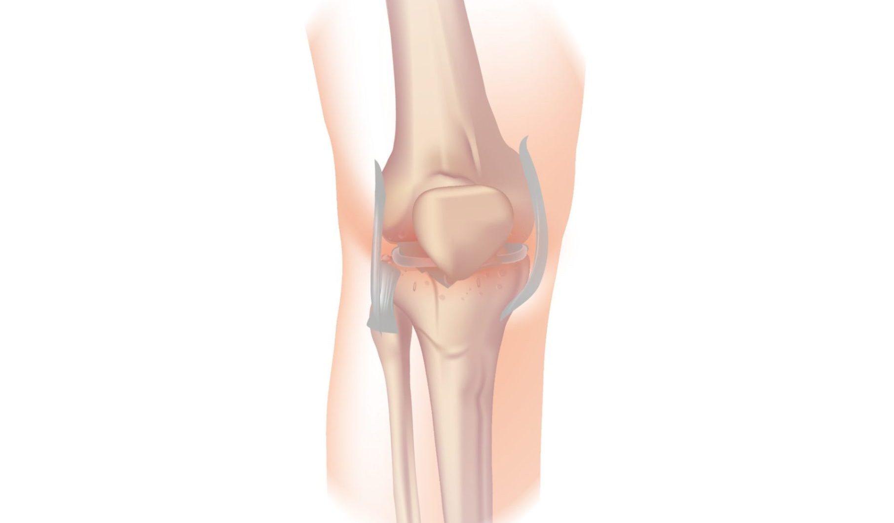 Medial collateral ligament (MCL) injury