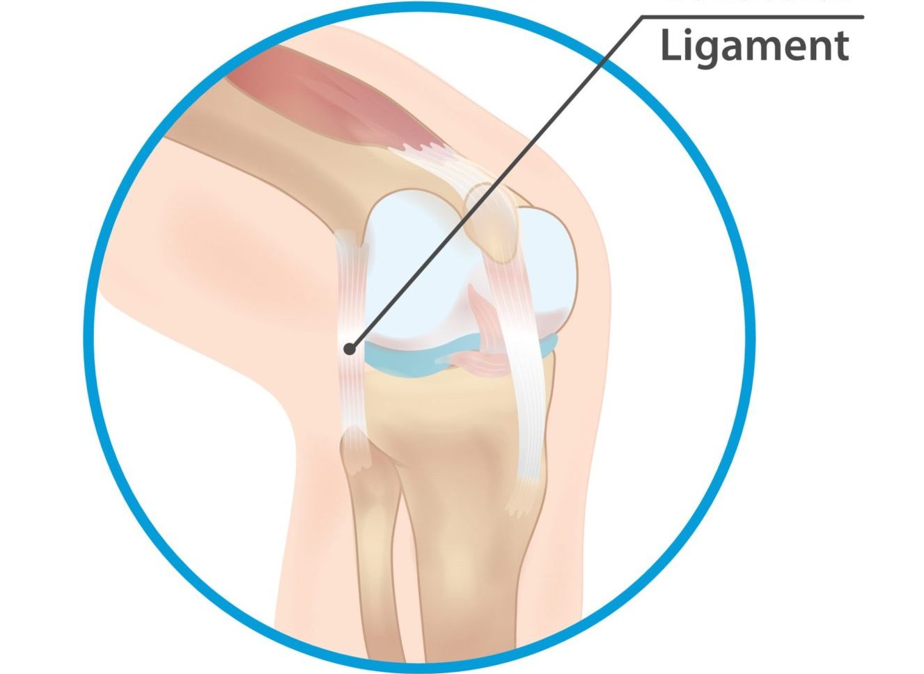 Lateral collateral ligament (LCL) injury