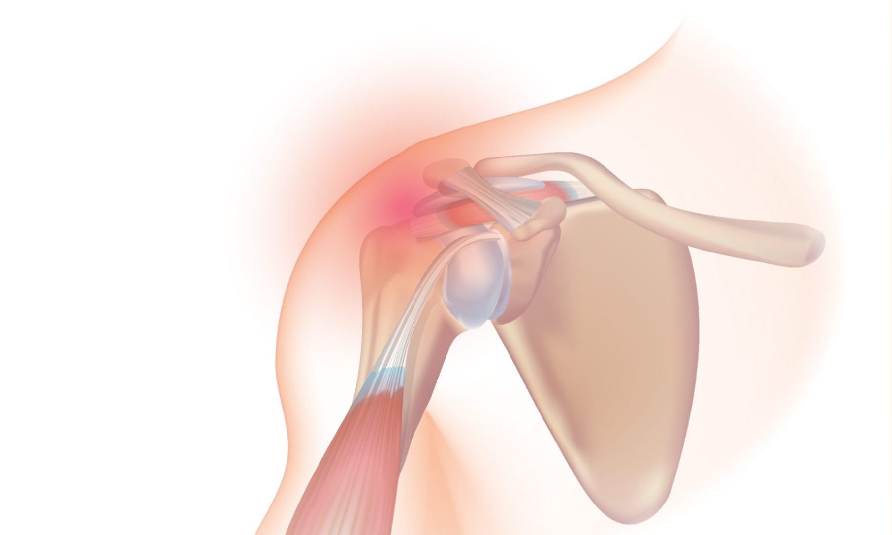 Multi-Directional Instability (MDI) of the Shoulder