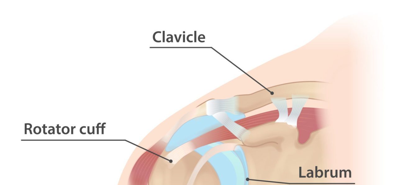 Acromio-Clavicular Joint Injury (AC Joint Sprain).