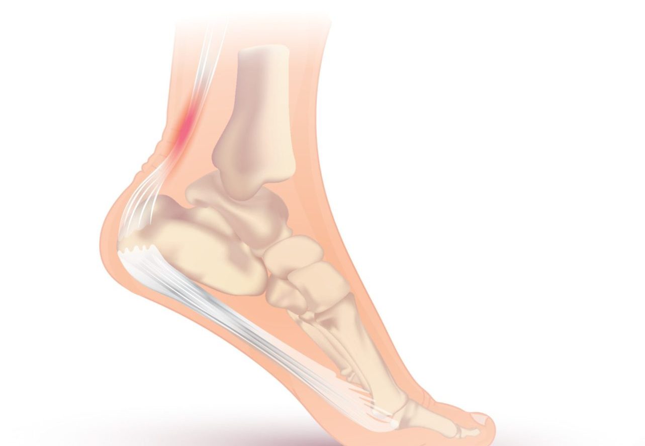 Achilles Tendinopathy