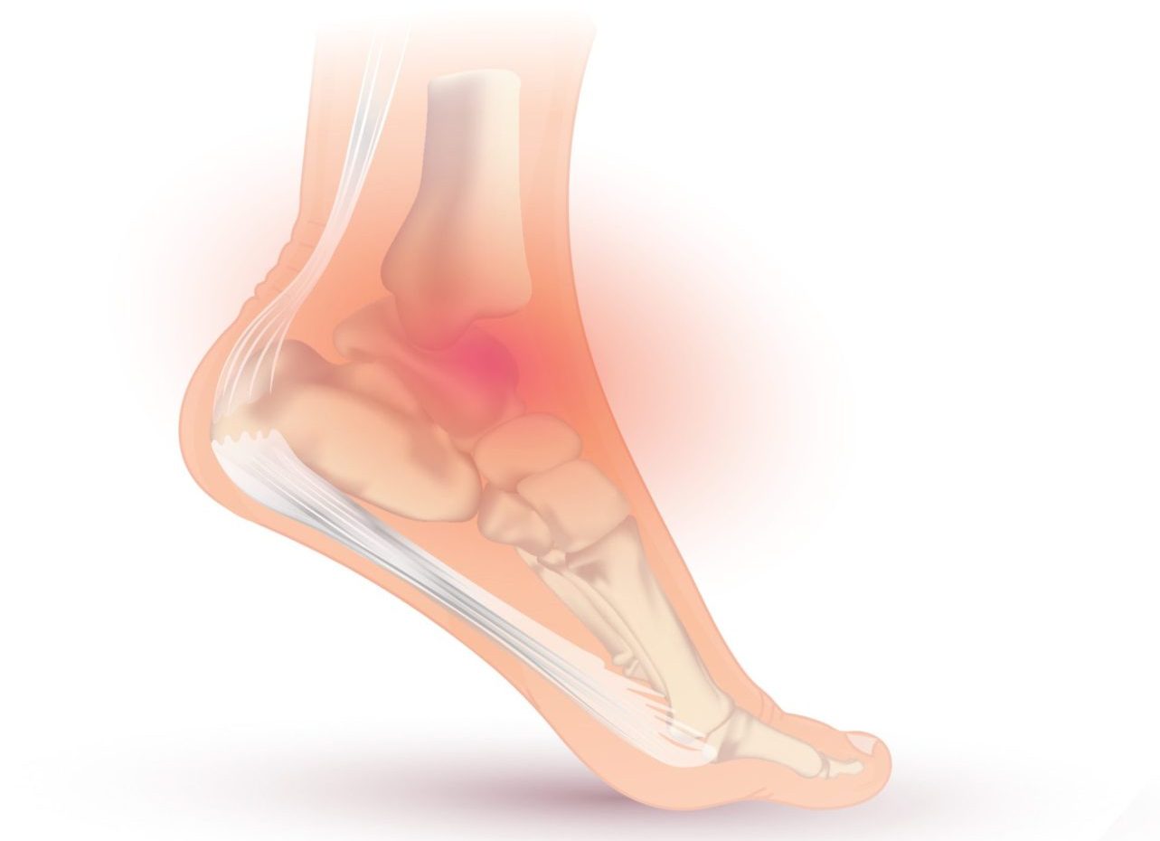 Medial Ankle Sprain