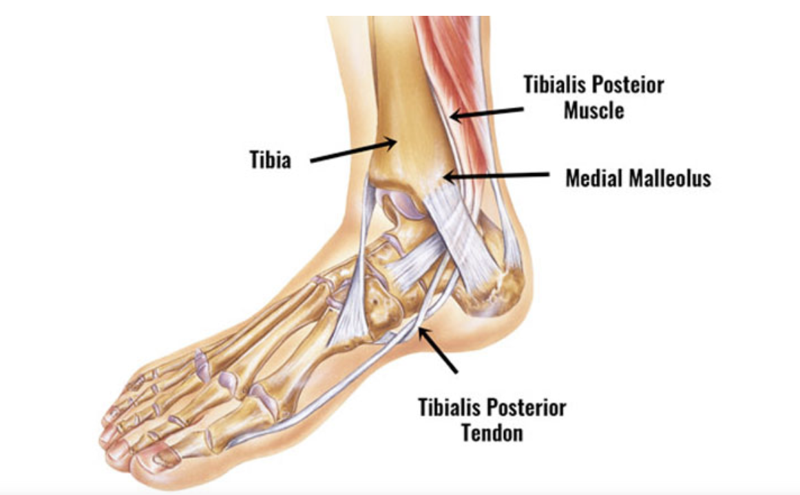 Tibialis Posterior Tendinopathy