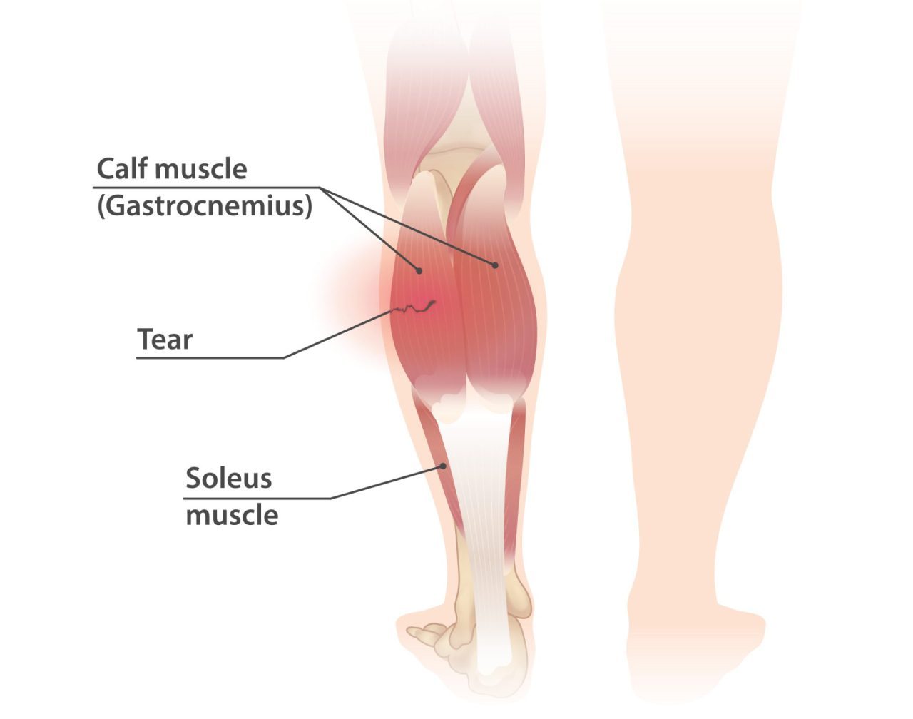 Calf muscle pain cause and treatment with 3 exercises