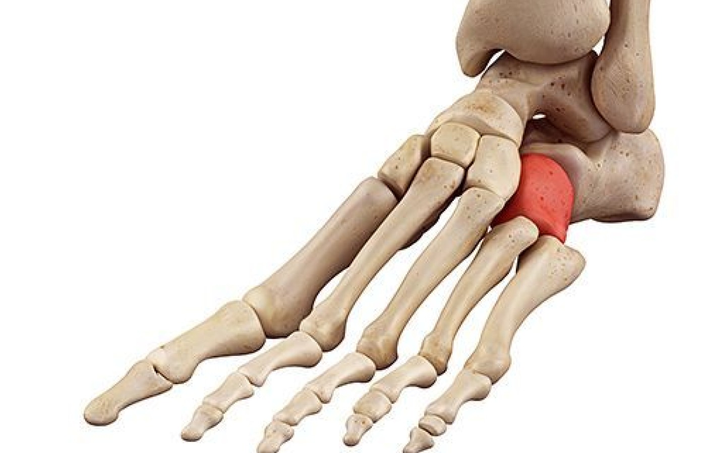 Cuboid Syndrome