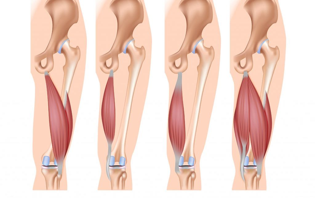 Hamstring Strain