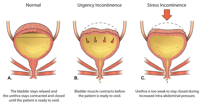 Stress Urinary Incontinence