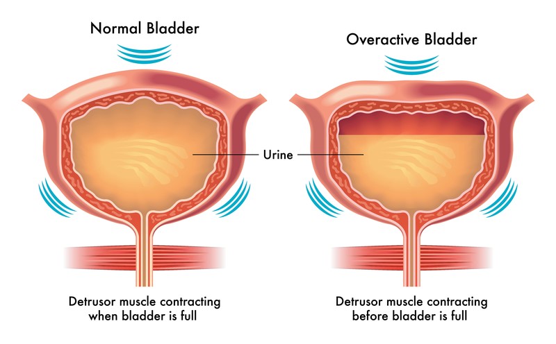 Overactive Bladder