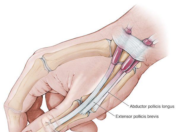 De Quervain’s Tenosynovitis