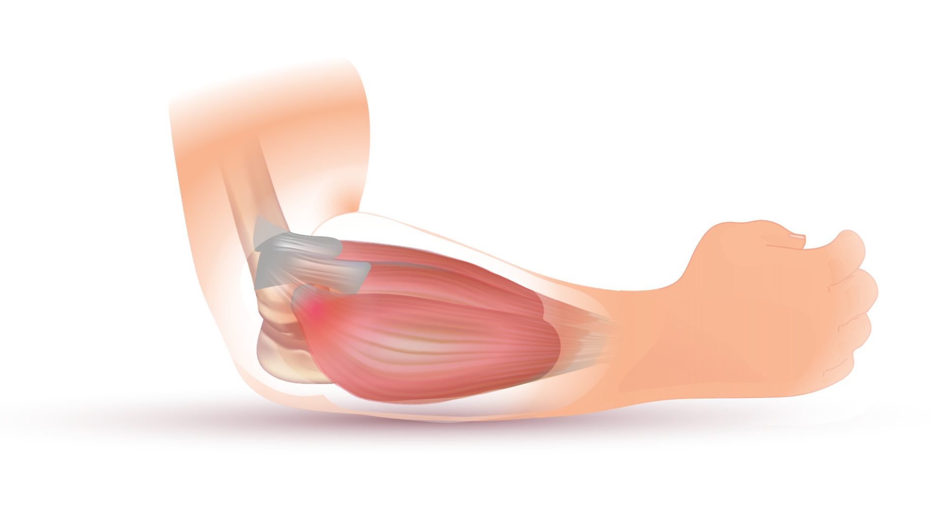Lateral Epicondylitis (Tennis Elbow)