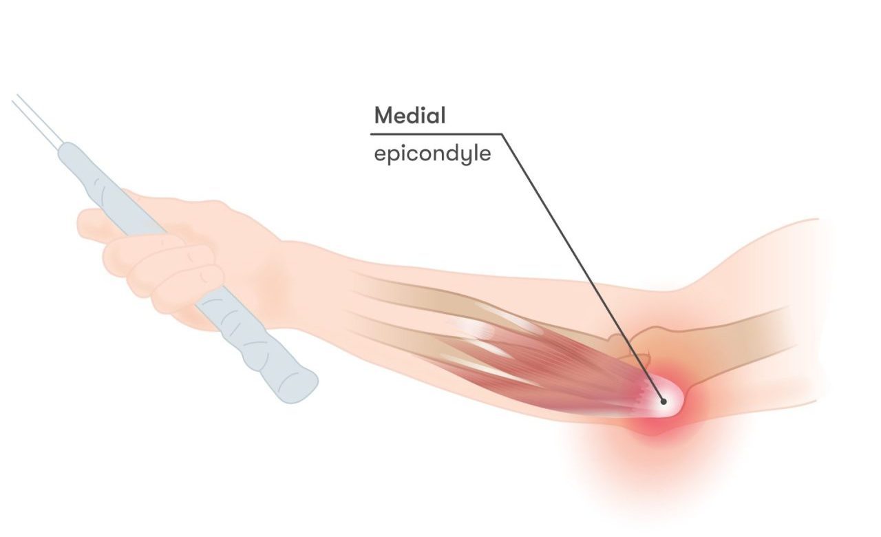 Medial Epicondylitis (Golfer’s Elbow)