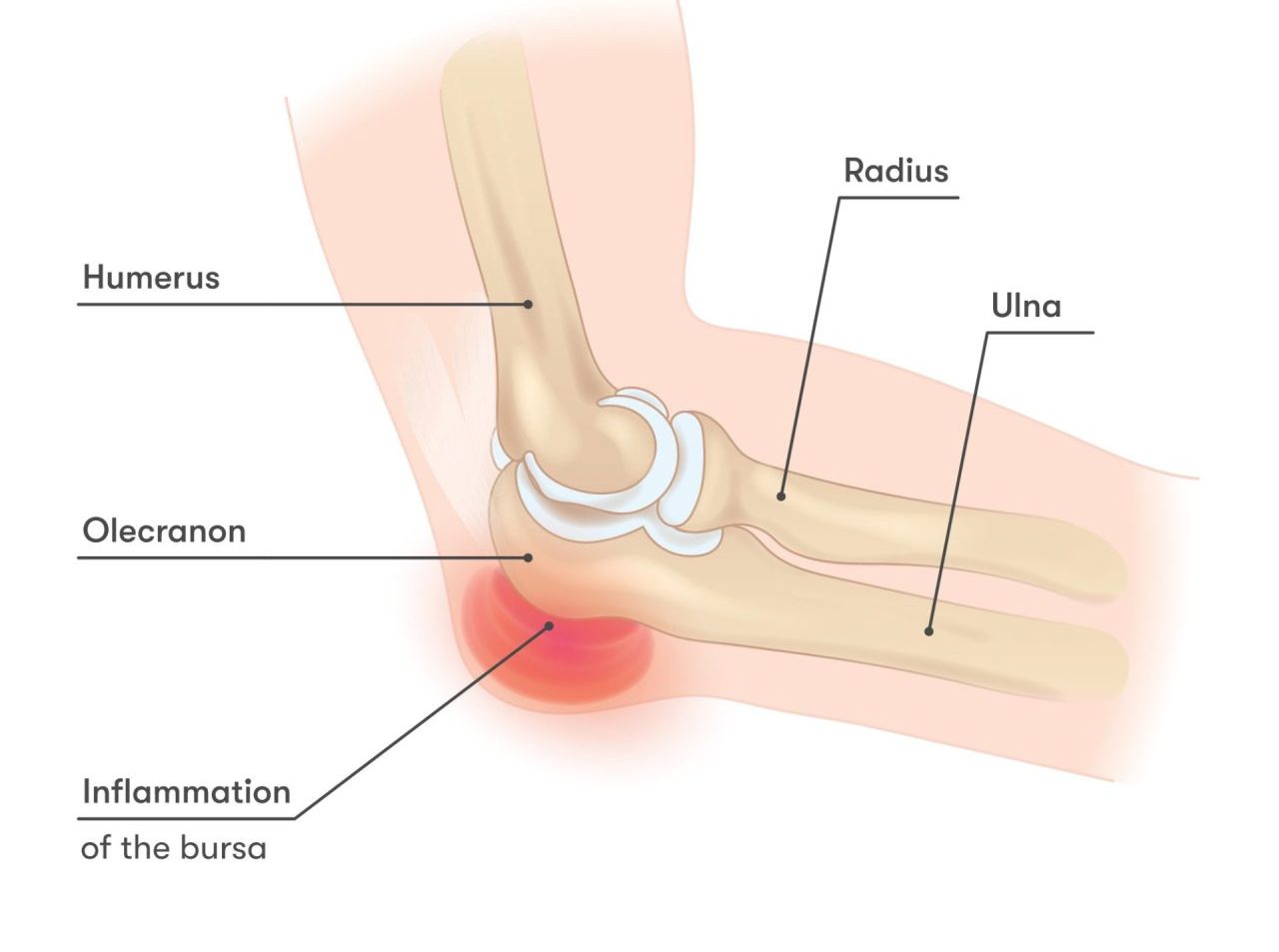 Olecranon Bursitis