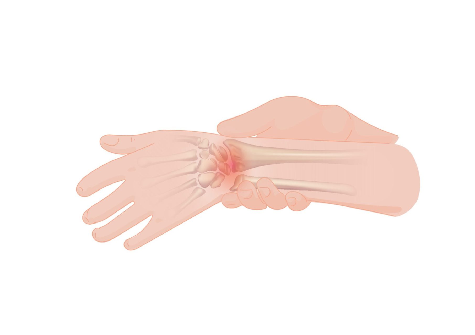 Wrist Impingement